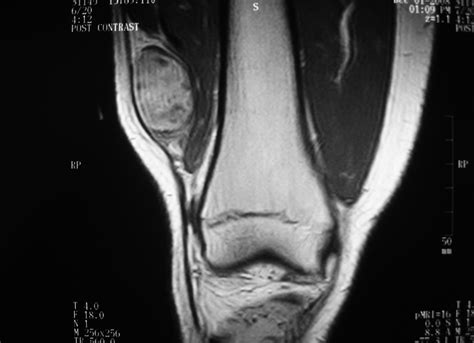 Synovial Sarcoma: Soft Tissue Sarcoma