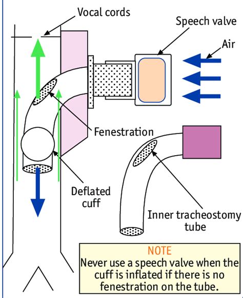 Sketch of the airflow through a fenestrated tracheostomy tube with a... | Download Scientific ...