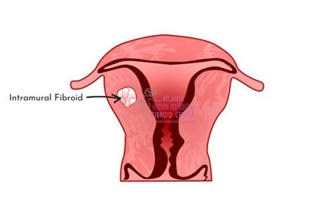 Intramural Fibroids Explained by Dr. John C. Lipman