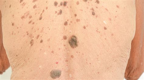 Age & Liver Spots: Symptoms, Causes, & Treatment - Toronto Dermatology Centre