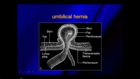 Supraumbilical Hernia Ultrasound