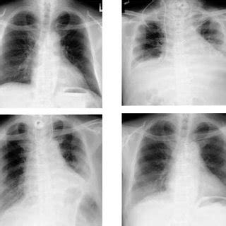 (PDF) Diaphragmatic plication in adult patients with diaphragm paralysis after cardiac surgery.