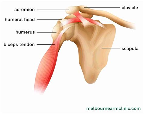 Bicep Tendon Tear at the Shoulder – Melbourne Arm Clinic