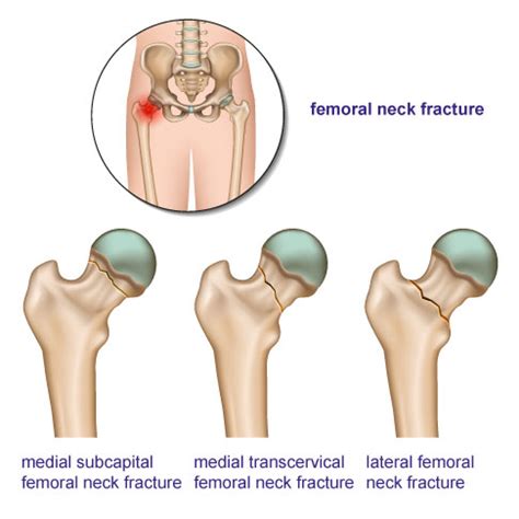 Femoral neck fractures | Joint-surgeon.com