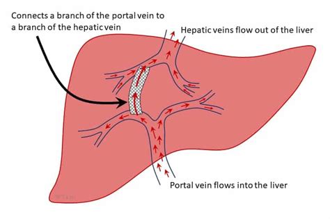 Transjugular Intrahepatic Portosystemic Shunt: TIPS