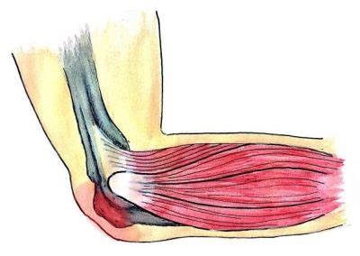 Olecranon Bursitis - Beachbox Physiotherapy