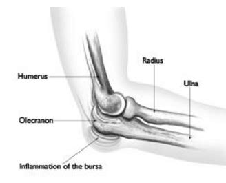 Olecranon Bursitis – Jason H. Tam, M.D