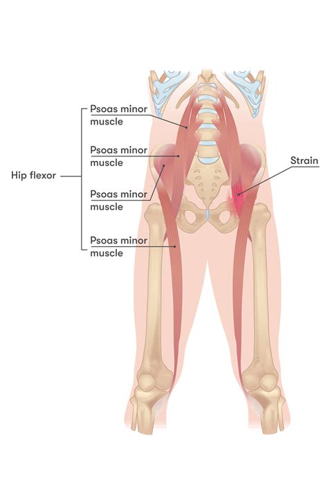 Hip Flexor Pain Causes