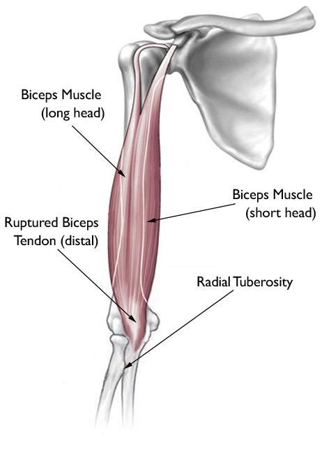 Injections for Distal Bicep Tendon | Steroid Injections For Biceps Pain | Distal Bicep Tendon ...