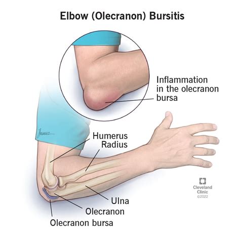 Elbow (Olecranon) Bursitis: Symptoms, Causes & Treatment