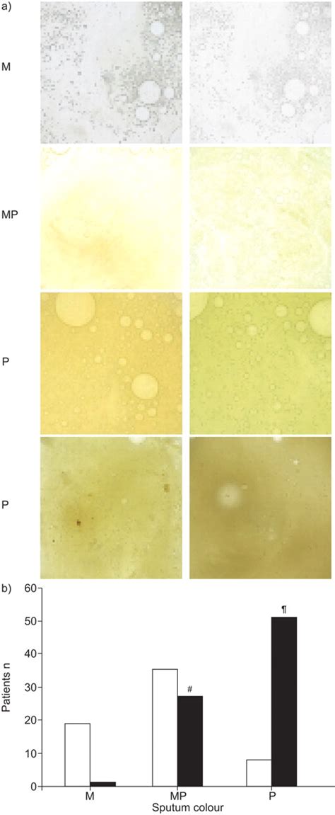 Sputum colour: a useful clinical tool in non-cystic fibrosis bronchiectasis | European ...