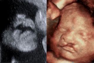 3d vs 4d baby ultrasound - Derlogos