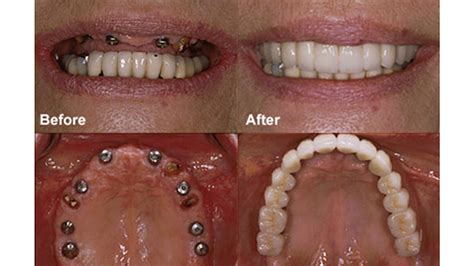 dental-implants Before and after | Dr. Ari Greenspan Dentist