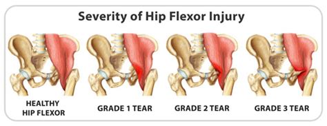 Hip Flexor Strain: Signs, Causes, Treatment and Recovery | IYTmed.com