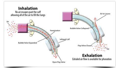 Tracheostomy Tube