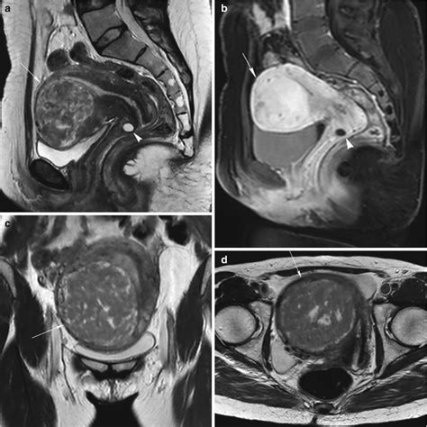 Ultrasound Imaging Fibroid Complicating A Possible