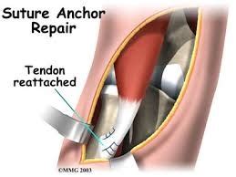 What is a Biceps Tendon Rupture and How is it Fixed?