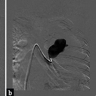 (a) Angiogram with the catheter in the left pulmonary artery showing... | Download Scientific ...