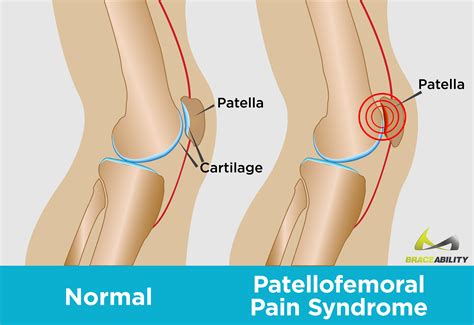 Patellofemoral Pain Syndrome Stretching - Pregnant Health Tips