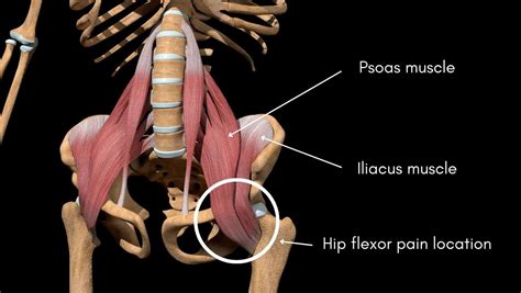 Hip Flexor Pain | Anatomy, Causes, and Treatment