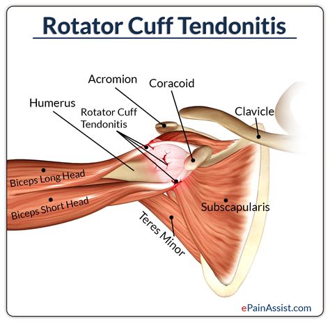 Massage Therapy for Rotator Cuff Tendonitis|Deep Tissue Massage|Deep Friction Massage