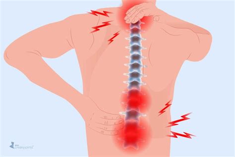 Arthritis in the Back: Symptoms, Types of Back Arthritis, Treatment