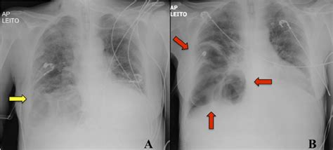 Lateral Chest X Ray Diaphragm