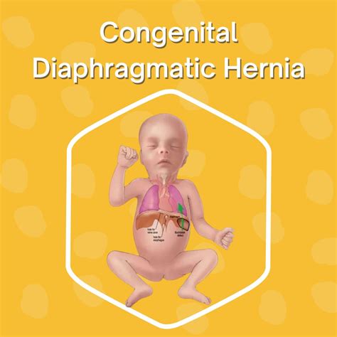 Understanding Congenital Diaphragmatic Hernia | Dr. Geeta Kekre