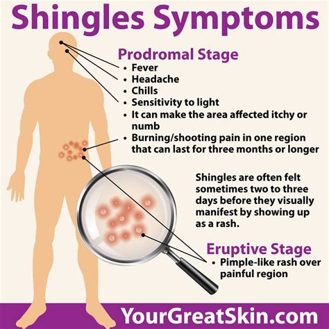 Shingles Symptoms No Rash Treatment - Infoupdate.org