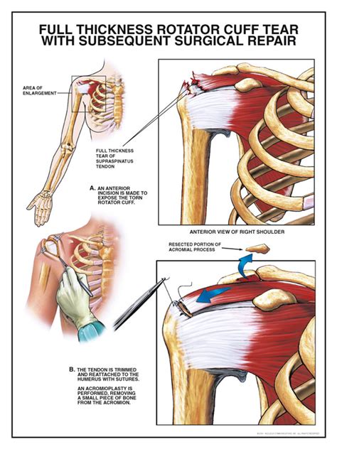 Full Thickness Rotator Cuff Tear with Subsequent Surgery