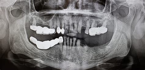 Cantilever dental bridge design and ADA dental code - Bauer Smiles