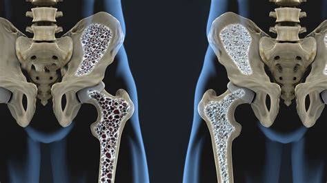 Metabolic bone disease