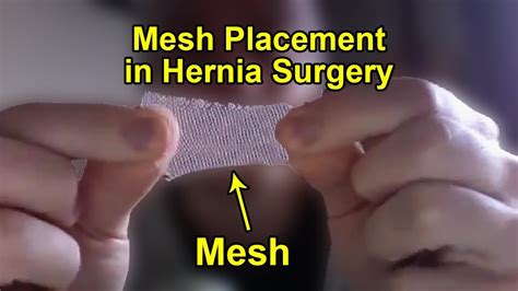 No Mesh Hernia Repair