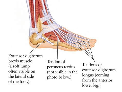 Foot tendons, running shoe arch support insoles, callus on bottom of foot with hole in center