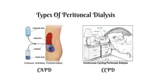 Peritoneal Dialysis Catheter Types