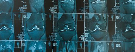 Knee MRI scan