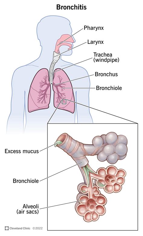 Bronchitis: Causes, Symptoms, Diagnosis & Treatment