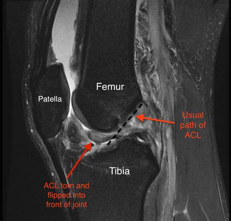 Torn ACL - Symptoms and Diagnosis - Jeffrey H. Berg, M.D.