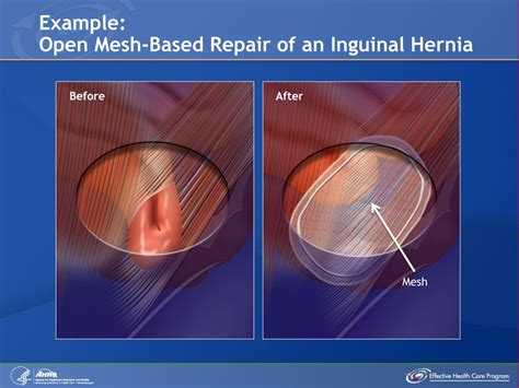 Hernia Mesh Types