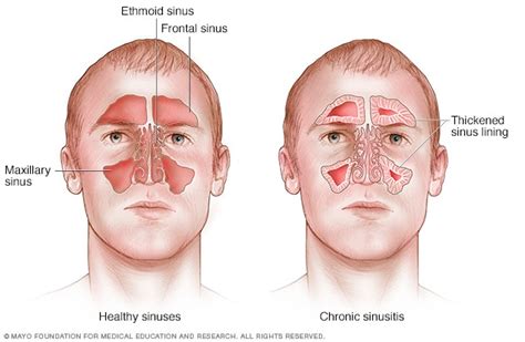 paranasal sinuses