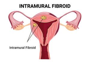 Intramural Fibroid - Vein & Endovascular Medical Care