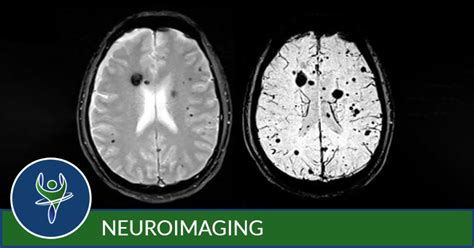 Neuroimaging - Capitol Imaging Services