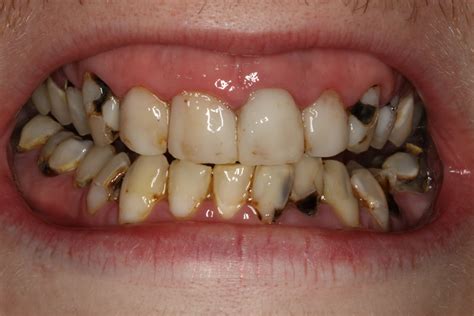 Tooth Decay Pictures - Phoenix Dentist | Chandler Dentist | Low Prices & Same Day Service