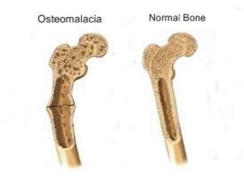 Metabolic bone disease