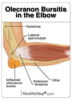 Elbow Bursitis