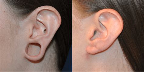 Ear lobe repair | Nivi Skin Clinic