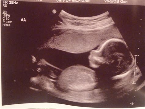 Baby Bitty Twins: 18 week ultrasound pics