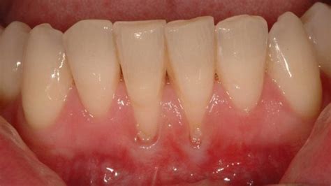 Receding Gums – Lane Ends Dental Practice – Preston