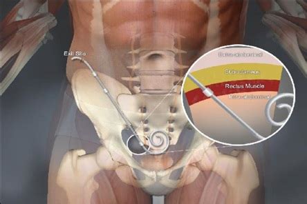 Peritoneal Dialysis Catheter Placement - Gwinnett Surgical Specialists