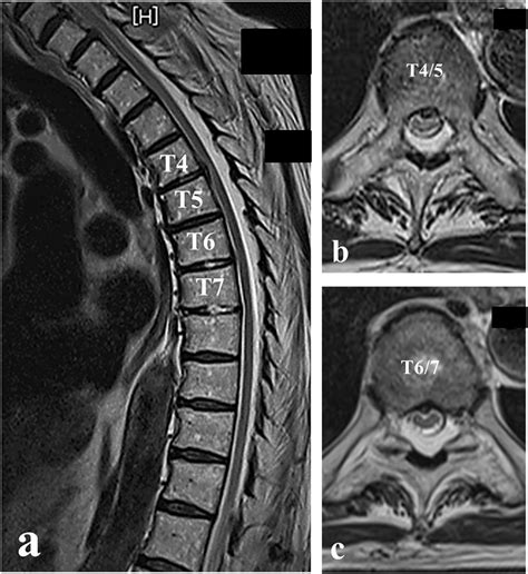 Mri Thoracic Spine Bulging Disc | sexiezpix Web Porn